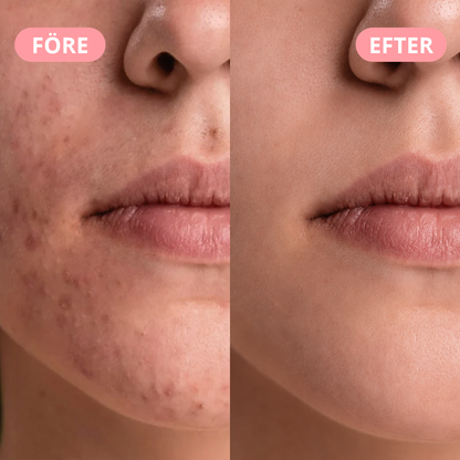 BetterSkin – Korean Acne Cream